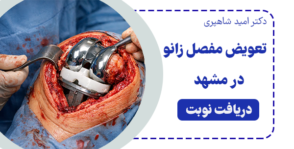 تعویض مفصل زانو